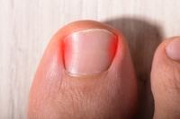 Understanding and Managing Pincer Nails